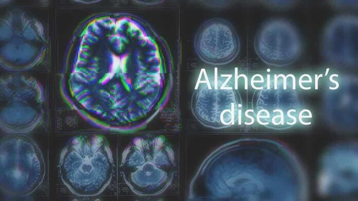 1054068035 featured image Brain scans labeled Alzheimers disease background