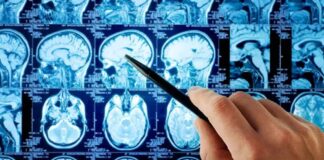 A hand pointing at MRI brain scans displayed on a screen